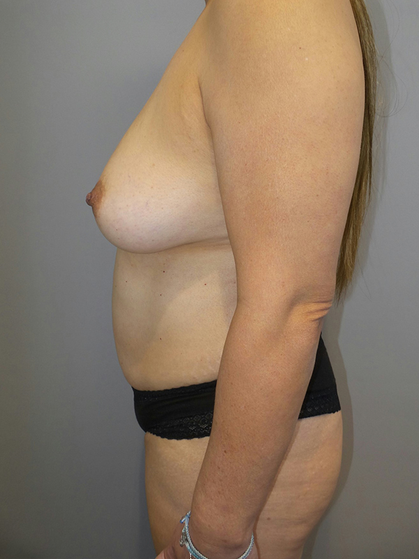 Mommy Makeover Before and After 28 | Grover Aesthetics