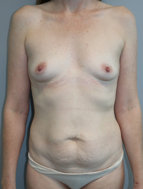 Mommy Makeover Before and After | Grover Aesthetics