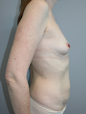 Mommy Makeover Before and After 29 | Grover Aesthetics