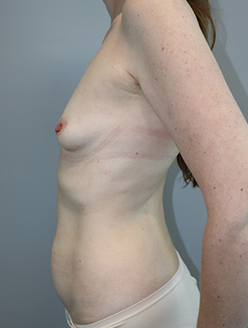 Mommy Makeover Before and After 31 | Grover Aesthetics