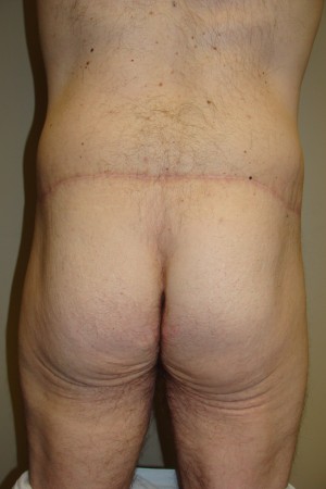 Thigh Lift Before and After | Grover Aesthetics