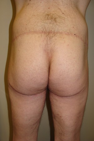 Thigh Lift Before and After | Grover Aesthetics