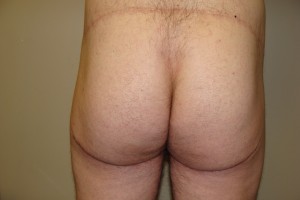 Thigh Lift Before and After 01 | Grover Aesthetics