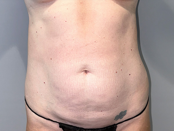 Tummy Tuck Before and After | Grover Aesthetics