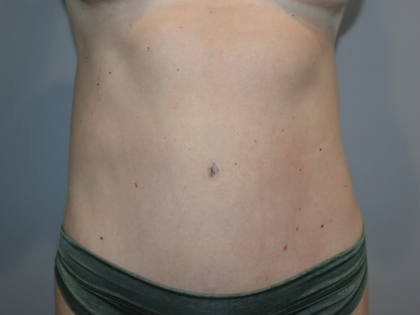 Tummy Tuck Before and After | Grover Aesthetics