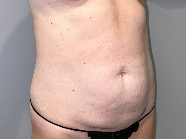 Tummy Tuck Before and After 01 | Sanjay Grover MD FACS