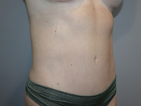 Tummy Tuck Before and After 01 | Grover Aesthetics