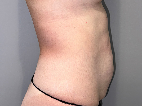 Tummy Tuck Before and After 01 | Grover Aesthetics