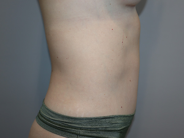 Tummy Tuck Before and After 01 | Grover Aesthetics