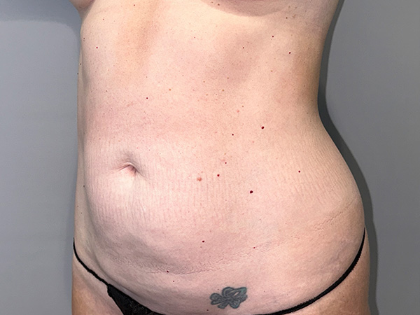 Tummy Tuck Before and After 01 | Grover Aesthetics