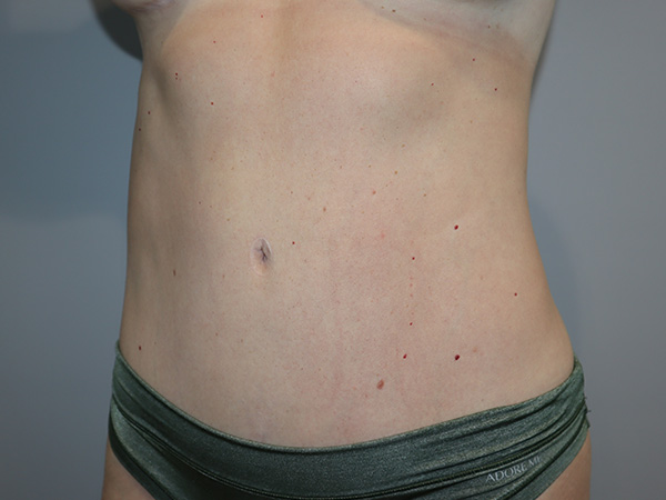 Tummy Tuck Before and After 01 | Grover Aesthetics