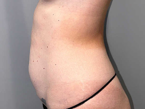 Tummy Tuck Before and After 01 | Grover Aesthetics