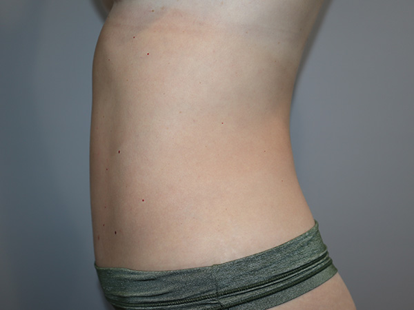 Tummy Tuck Before and After 01 | Grover Aesthetics