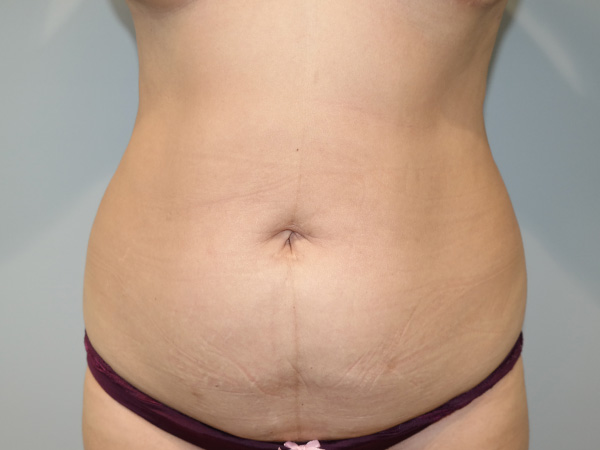 Tummy Tuck Before and After 60 | Sanjay Grover MD FACS