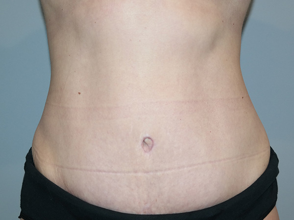 Tummy Tuck Before and After 02 | Sanjay Grover MD FACS