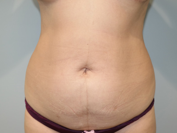 Tummy Tuck Before and After 55 | Sanjay Grover MD FACS