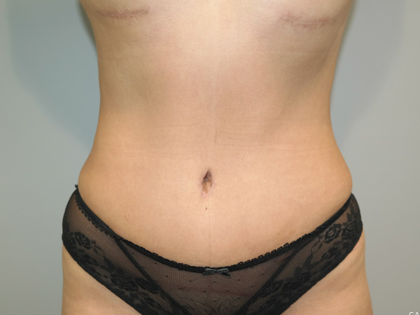 Tummy Tuck Before and After 03 | Sanjay Grover MD FACS