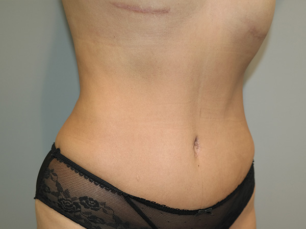 Tummy Tuck Before and After 03 | Grover Aesthetics