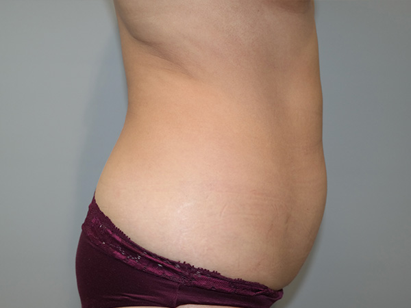 Tummy Tuck Before and After 03 | Sanjay Grover MD FACS