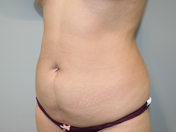 Tummy Tuck Before and After 03 | Grover Aesthetics