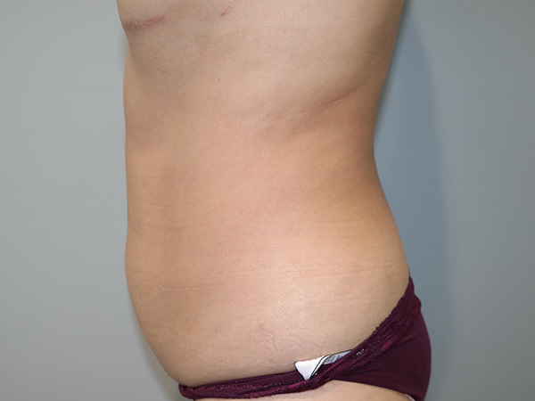 Tummy Tuck Before and After 03 | Sanjay Grover MD FACS