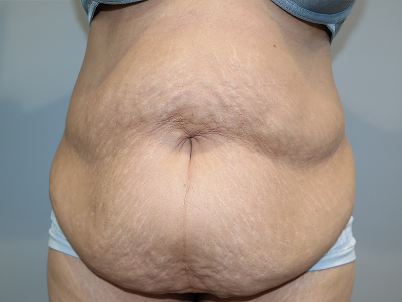 Tummy Tuck Before and After 73 | Sanjay Grover MD FACS