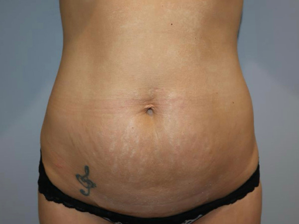 Tummy Tuck Before and After | Grover Aesthetics