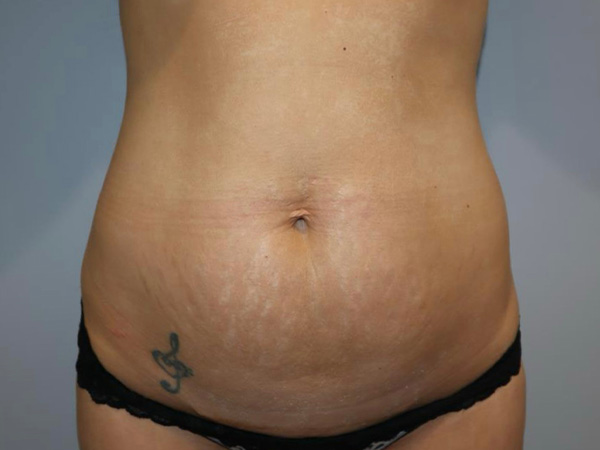 Tummy Tuck Before and After 23 | Sanjay Grover MD FACS