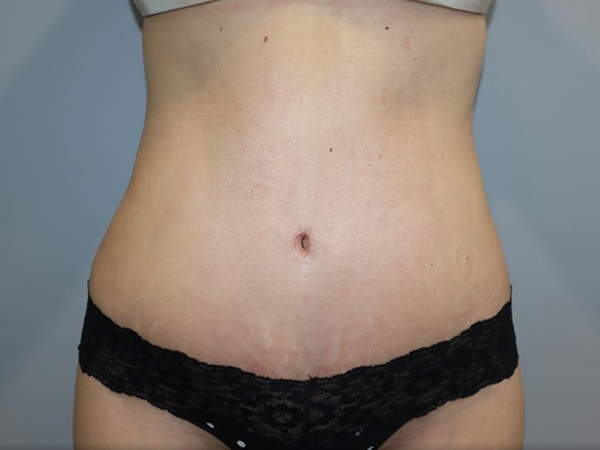 Tummy Tuck Before and After 04 | Sanjay Grover MD FACS