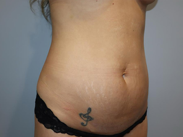 Tummy Tuck Before and After 04 | Sanjay Grover MD FACS