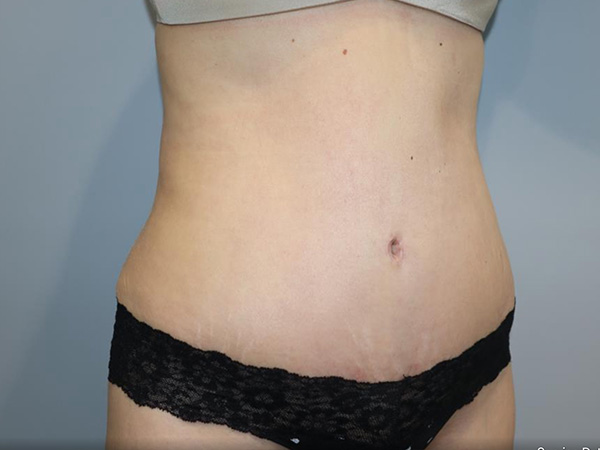 Tummy Tuck Before and After 04 | Sanjay Grover MD FACS