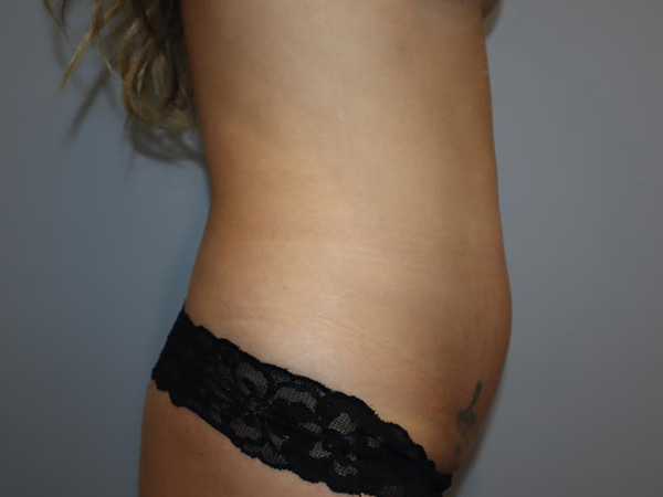 Tummy Tuck Before and After 04 | Grover Aesthetics