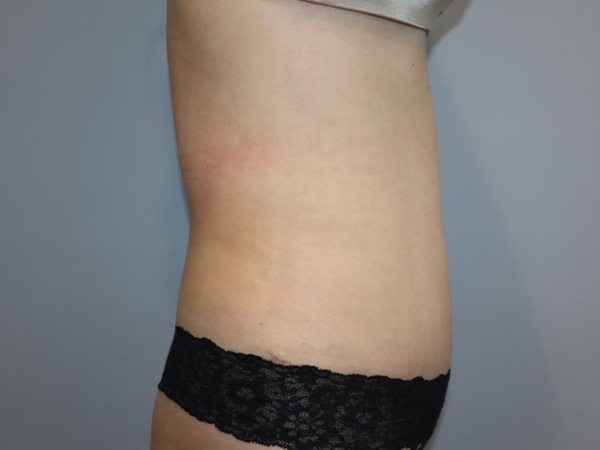 Tummy Tuck Before and After 04 | Grover Aesthetics