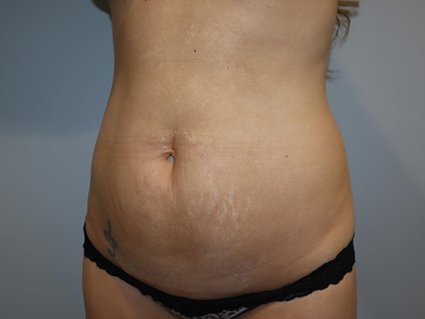 Tummy Tuck Before and After 04 | Sanjay Grover MD FACS