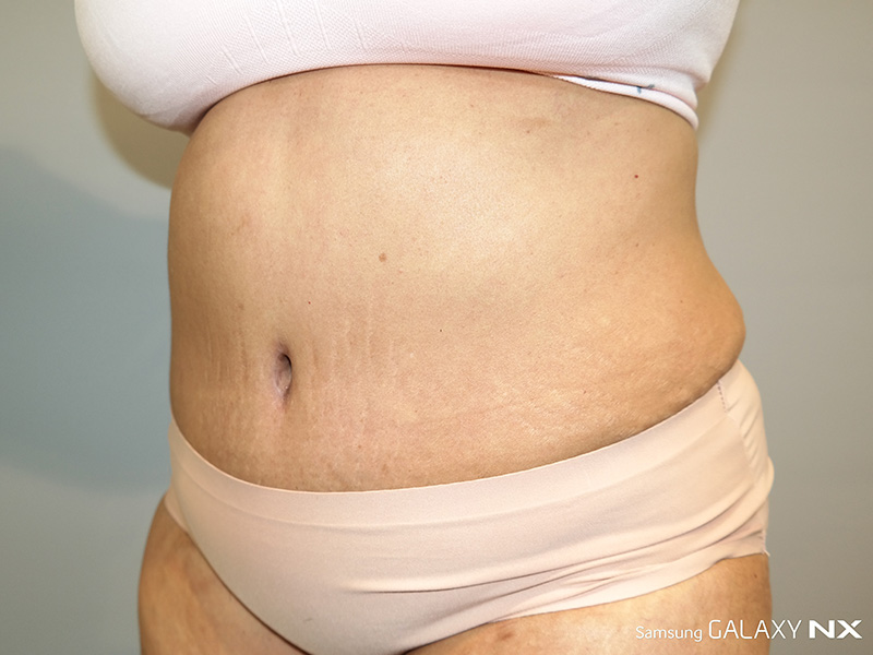 Tummy Tuck Before and After 04 | Sanjay Grover MD FACS