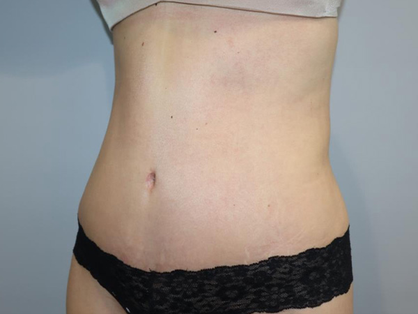 Tummy Tuck Before and After 04 | Sanjay Grover MD FACS