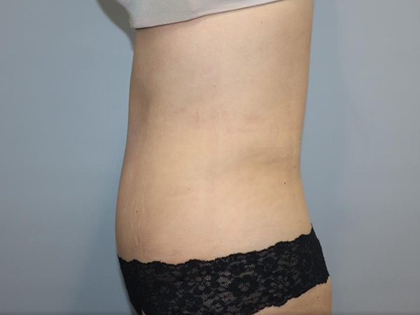 Tummy Tuck Before and After 04 | Sanjay Grover MD FACS