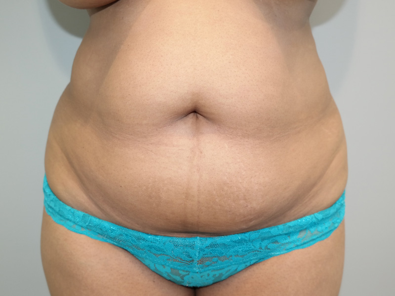 Tummy Tuck Before and After | Grover Aesthetics