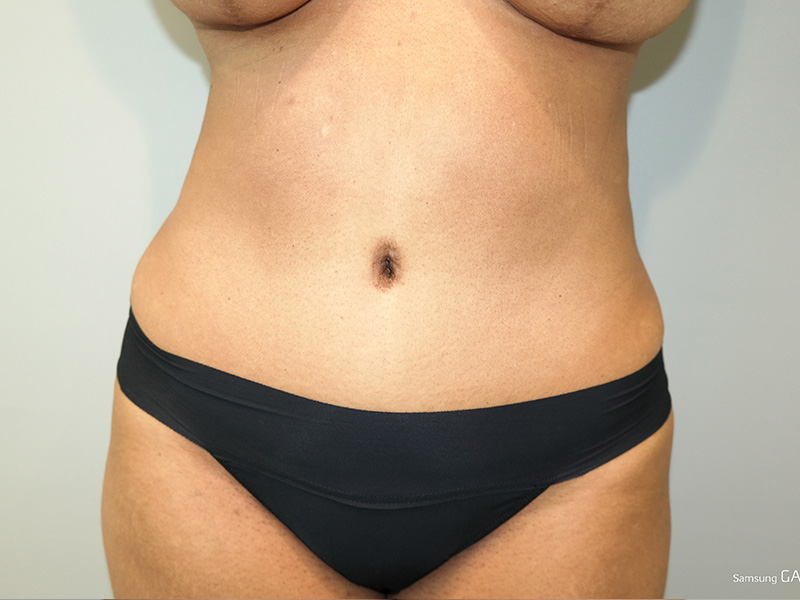 Tummy Tuck Before and After | Grover Aesthetics
