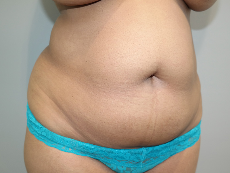 Tummy Tuck Before and After 05 | Sanjay Grover MD FACS