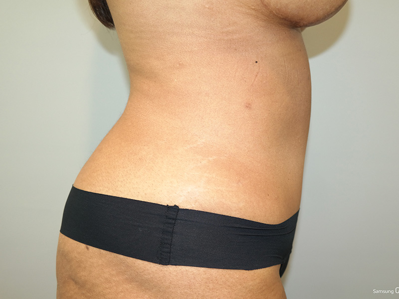 Tummy Tuck Before and After 05 | Sanjay Grover MD FACS