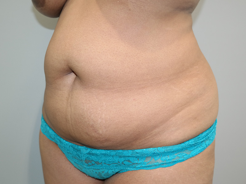 Tummy Tuck Before and After 05 | Sanjay Grover MD FACS