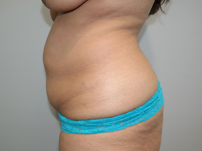 Tummy Tuck Before and After 05 | Sanjay Grover MD FACS