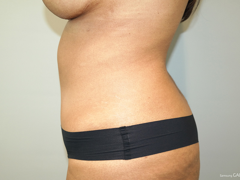 Tummy Tuck Before and After 05 | Sanjay Grover MD FACS