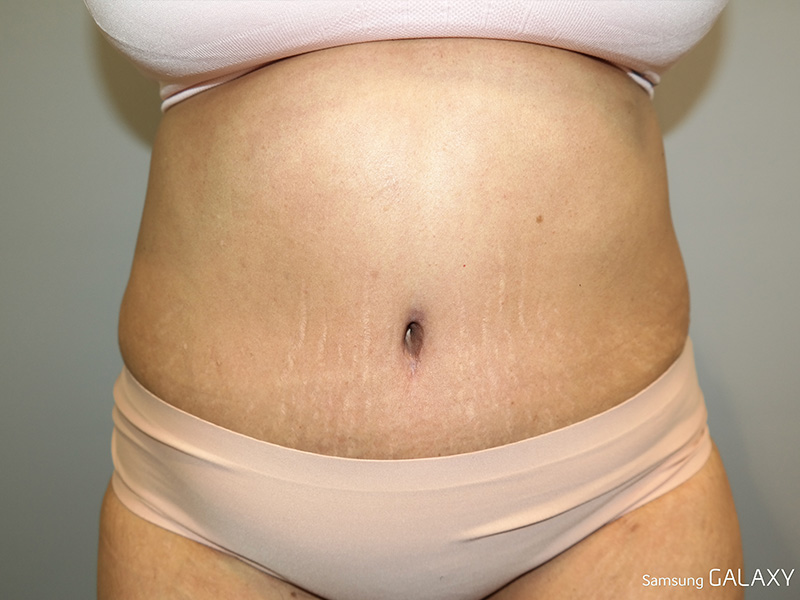 Tummy Tuck Before and After 06 | Sanjay Grover MD FACS