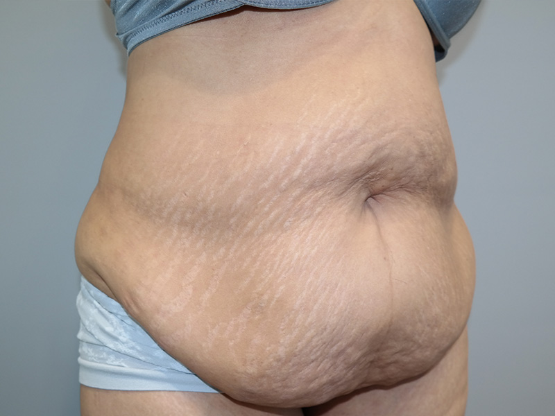 Tummy Tuck Before and After 06 | Sanjay Grover MD FACS