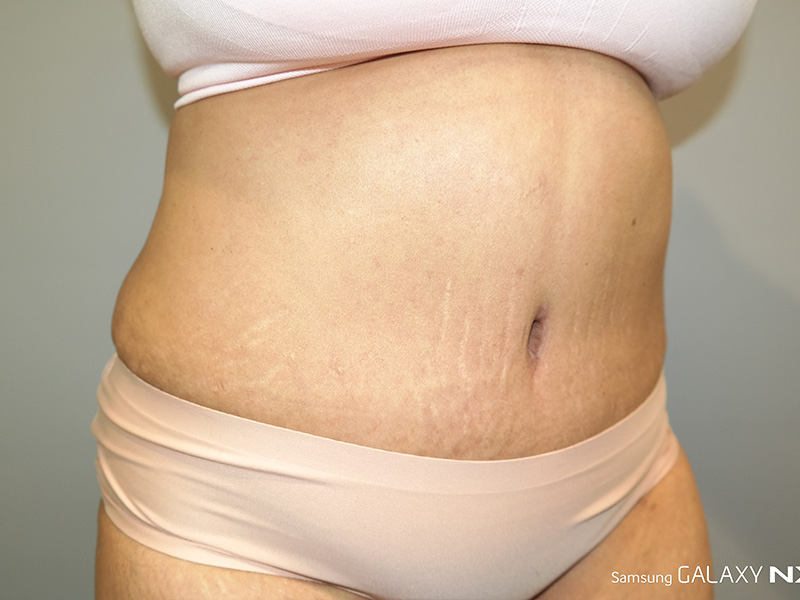 Tummy Tuck Before and After 06 | Sanjay Grover MD FACS