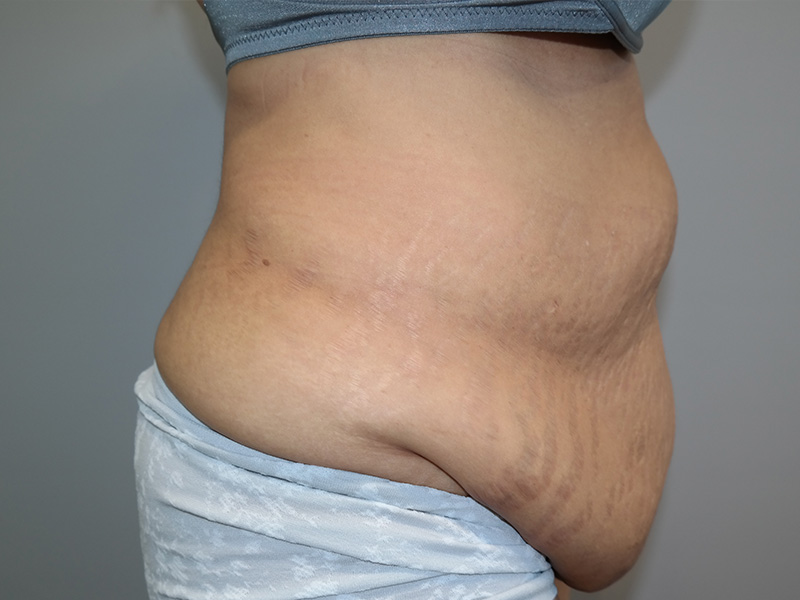 Tummy Tuck Before and After 06 | Sanjay Grover MD FACS