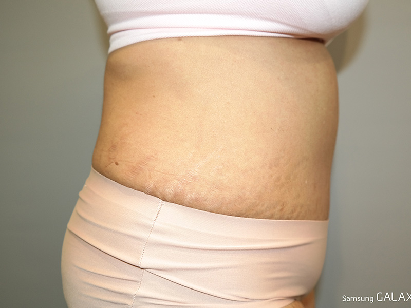 Tummy Tuck Before and After 06 | Sanjay Grover MD FACS