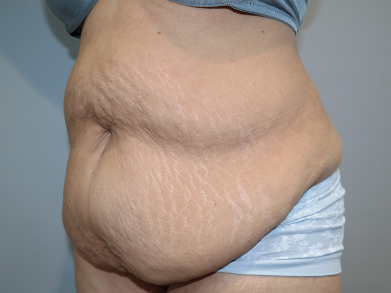 Tummy Tuck Before and After 06 | Sanjay Grover MD FACS